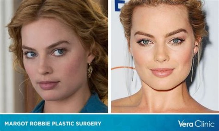 Margot Robbie’s Plastic Surgery (Nose Job), Age, Wiki, Bio, Wiki & More